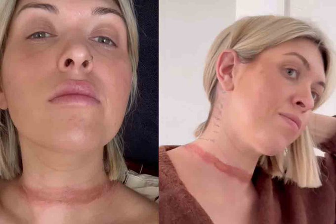 Από την εκδήλωση στον τρόμο: Influencer σε απρόσμενο ατύχημα (PHOTO)