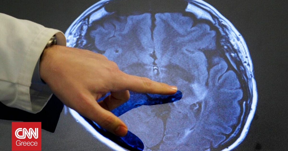 Aντιμετωπίστηκε με επιτυχία για πρώτη φορά η νόσος του Χάντινγκτον